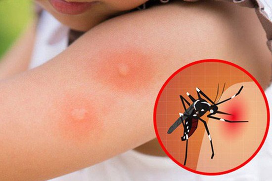 Hà Nội: Trong một tuần ghi nhận thêm 228 trường hợp mắc sốt xuất huyết, trong đó có nhiều trẻ nhỏ