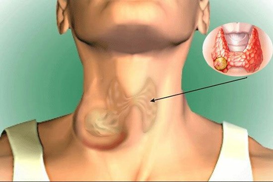 Ung thư tuyến giáp chiếm 90% bệnh nhân ung thư nội tiết, dấu hiệu âm thầm nhưng có thể điều trị được: Bác sĩ BV Bạch Mai chỉ rõ 5 điều quan trọng về căn bệnh này