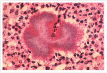 Đạp phải gai nhọn lúc trồng cây, 9 năm sau mới biết mình phải đối mặt với tử thần thầm lặng dưới cái tên bệnh ăn thịt người-4