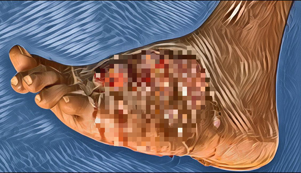 Đạp phải gai nhọn lúc trồng cây, 9 năm sau mới biết mình phải đối mặt với tử thần thầm lặng dưới cái tên bệnh ăn thịt người-3