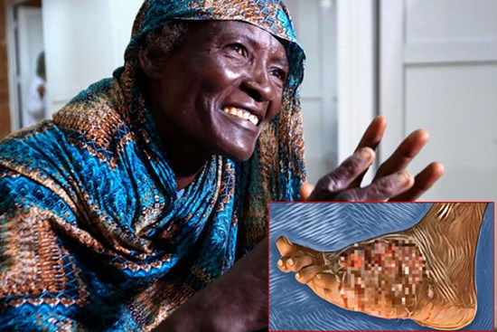 Đạp phải gai nhọn lúc trồng cây, 9 năm sau mới biết mình phải đối mặt với tử thần thầm lặng dưới cái tên 