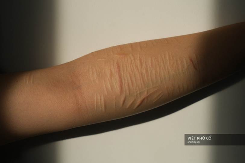 Nghe 2 bạn trẻ kể chuyện từng tự tử và trải nghiệm cảm giác cận kề cái chết: Muốn chết cũng khó lắm, cứ chai mặt sống đi rồi mọi việc sẽ ổn cả-8