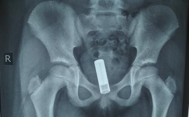 Lấy dị vật là viên pin bị ăn mòn ra khỏi âm đạo bé gái 7 tuổi-1