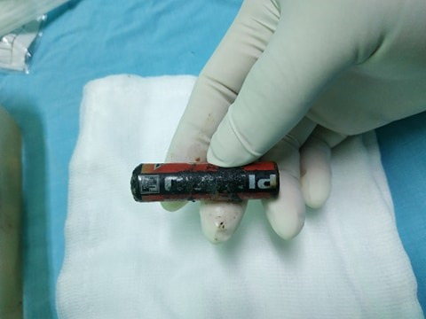 Lấy dị vật là viên pin bị ăn mòn ra khỏi âm đạo bé gái 7 tuổi-2