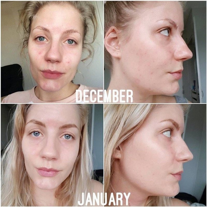 3 thành phần được ví như phép màu hồi sinh làn da bị nám, tàn nhang: Chị em ngoài 30 tuổi da đang lão hóa cần tìm hiểu ngay còn kịp-4