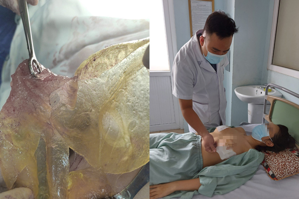 Người phụ nữ Hà Nội bị vỡ túi ngực sau 6 năm-1