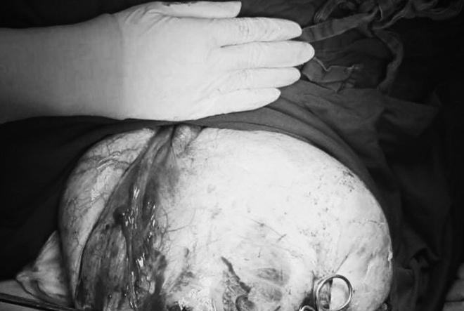 Bé gái mang khối u buồng trứng nặng 12 kg-1