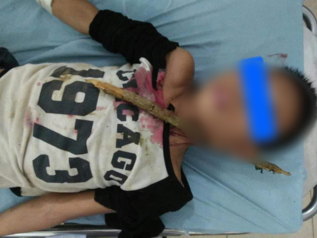 Tai nạn hy hữu: Bé trai ngã cây cà phê, bị cành cây xuyên thủng qua cổ-1