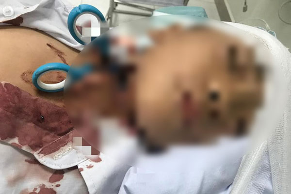 Bé trai 7 tuổi bị đau tai, đi châm cứu thì méo miệng, nháy mắt liên tục: Sau 1 lần lấy ráy tai, bác sĩ phát hiện ngay ra bệnh-4