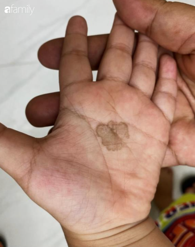 Nhiều cha mẹ tại TP.HCM đưa con đi cầu cứu bác sĩ vì bàn tay, bàn chân xuất hiện các tổn thương lạ-2