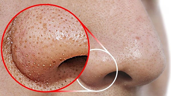 Beauty blogger người Nhật dạy cách trị mụn đầu đen ngay từ bước rửa mặt, nhấn mạnh việc nặn hay lột mụn sẽ khiến da lão hóa cực nhanh-1