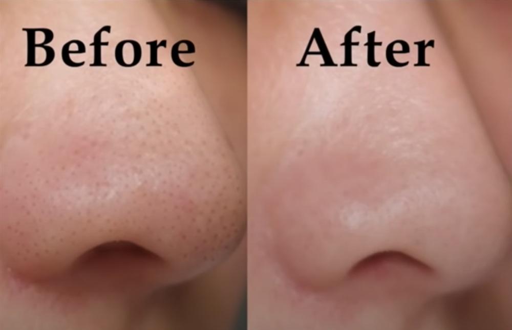 Beauty blogger người Nhật dạy cách trị mụn đầu đen ngay từ bước rửa mặt, nhấn mạnh việc nặn hay lột mụn sẽ khiến da lão hóa cực nhanh-4