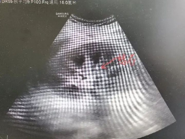 Chàng trai 18 tuổi phải vào viện chạy thận vì mỗi ngày đều uống thứ nước vạn người mê-2