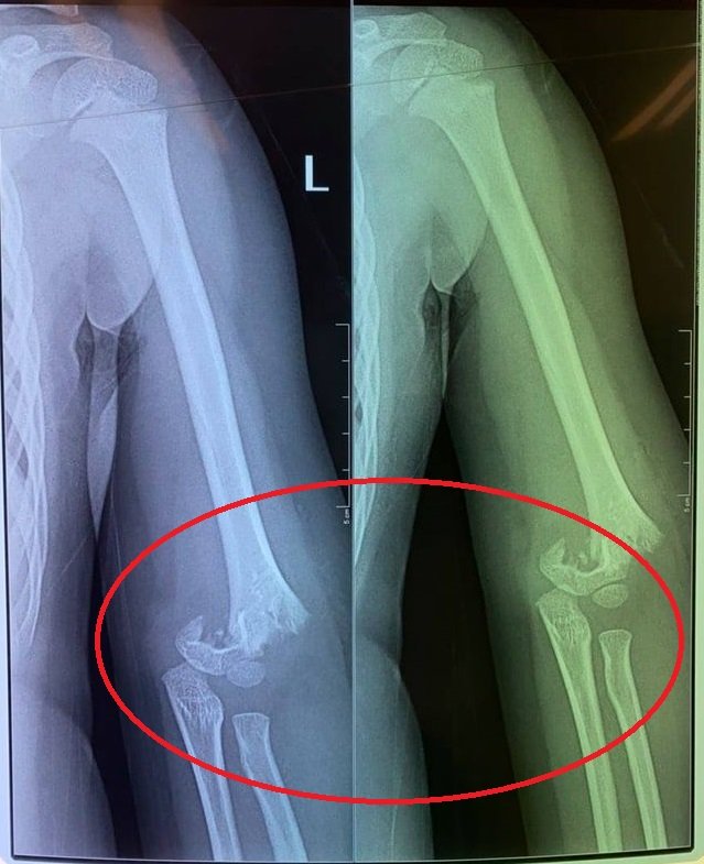 Bé gái 5 tuổi đi mẫu giáo bị bạn đẩy ngã gẫy tay nhưng cô giáo không đưa đi cấp cứu ngay, người mẹ chia sẻ: Nhà trường bặt vô âm tín!-1