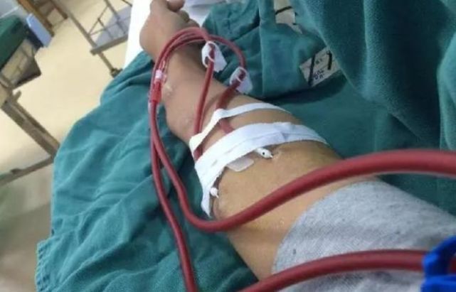 Thận của người đàn ông 32 tuổi bị lấp đầy với hơn 400 viên sỏi, bác sĩ thở dài: Đúng là kiểu ăn uống có hại nhưng người trẻ hay bỏ qua-2