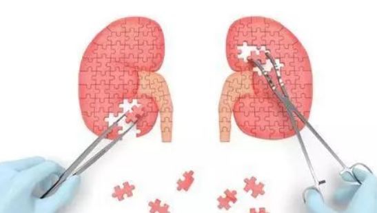 Thận của người đàn ông 32 tuổi bị lấp đầy với hơn 400 viên sỏi, bác sĩ thở dài: Đúng là kiểu ăn uống có hại nhưng người trẻ hay bỏ qua-5