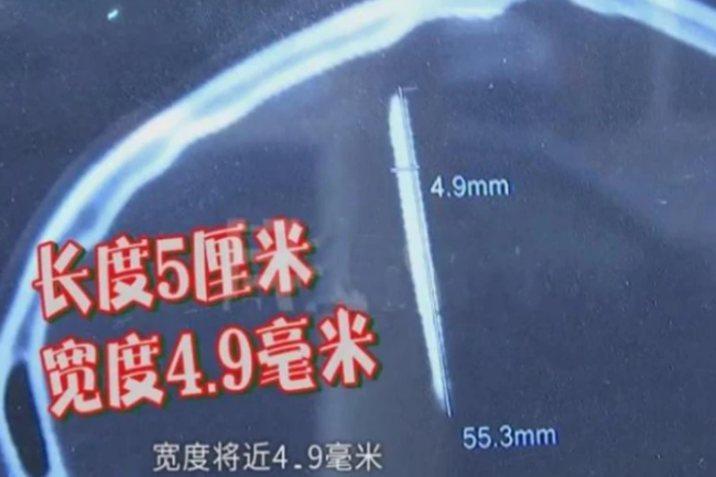 Phát hiện 2 mũi kim kỳ lạ trong đầu sau khi chụp CT não, người phụ nữ hoang mang khi biết được thân phận thật sự vào 29 năm trước-1