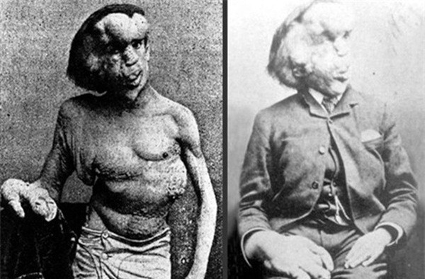 Cuộc đời đau khổ và ngắn ngủi của Người voi: Sinh ra mang vẻ ngoài khác biệt với những khối u lớn bí ẩn không lời giải đến tận ngày nay-2