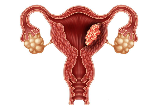 Bộ phận này dày lên, phụ nữ nguy cơ mắc ung thư tử cung-1