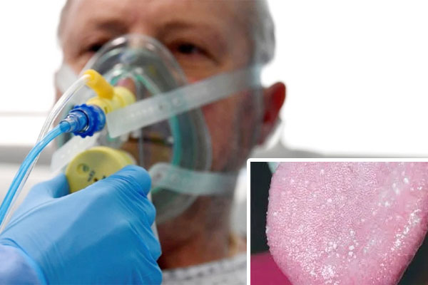 Bác sĩ cảnh báo triệu chứng mới trên lưỡi của Covid-19-1