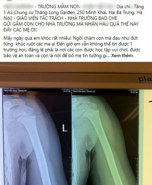 Nhà trường lên tiếng sau vụ bé gái 5 tuổi ngã gãy tay, nguy cơ bị liệt khi đang trong giờ học-1