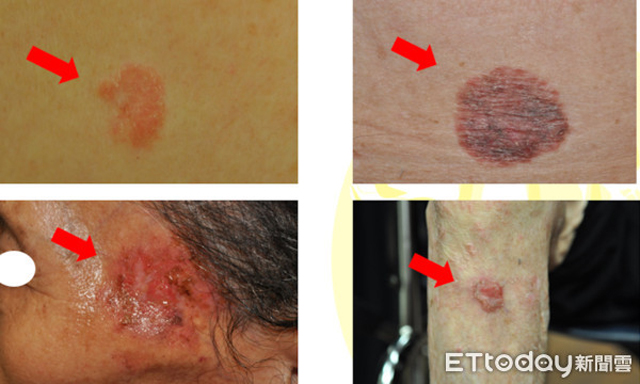 Chủ quan với vết ban đỏ trên trán, người phụ nữ không ngờ đó là dấu hiệu bệnh ung thư-2