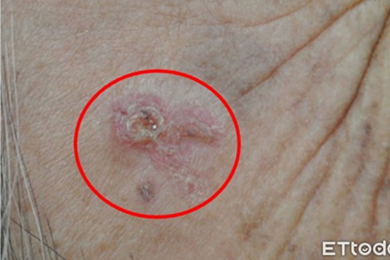 Chủ quan với vết ban đỏ trên trán, người phụ nữ không ngờ đó là dấu hiệu bệnh ung thư