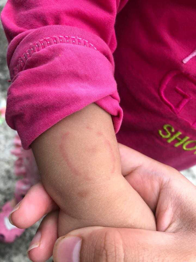 Con gái đi học mầm non bị bạn cùng lớp cào tím bầm cả má, mẹ uất ức vì cô giáo không gọi điện thông báo với phụ huynh-1