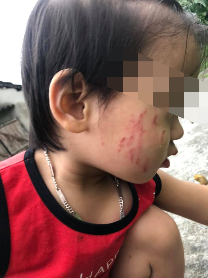 Con gái đi học mầm non bị bạn cùng lớp cào tím bầm cả má, mẹ uất ức vì cô giáo không gọi điện thông báo với phụ huynh-3