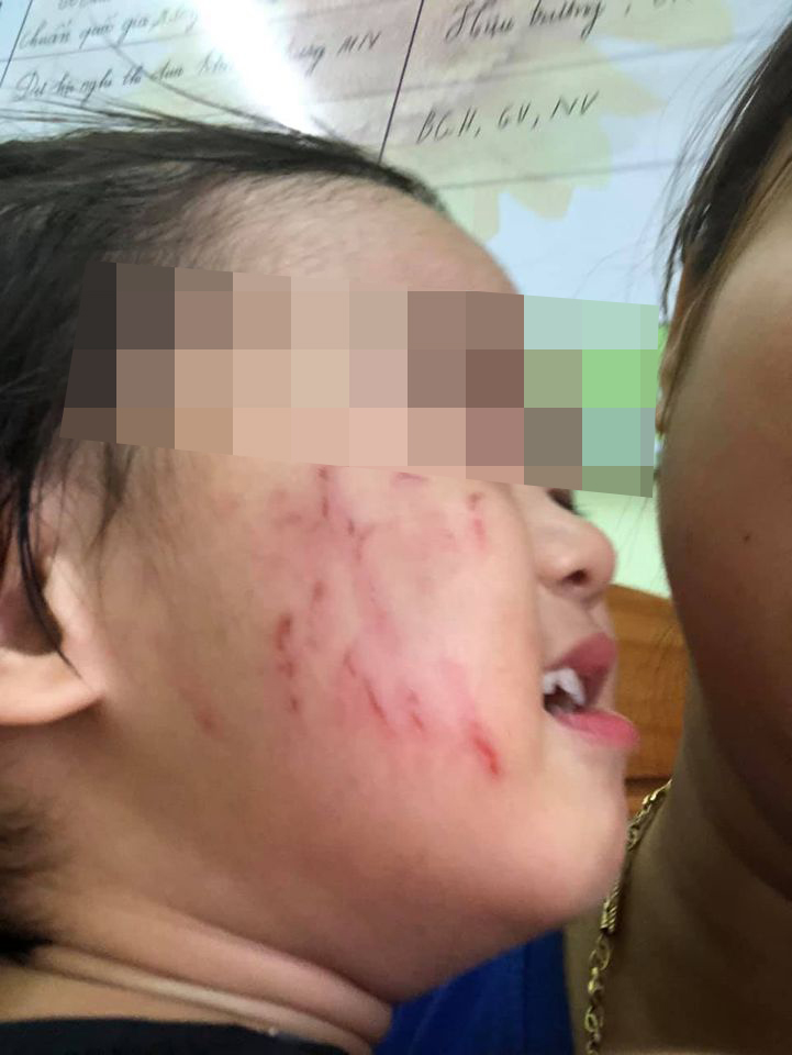 Con gái đi học mầm non bị bạn cùng lớp cào tím bầm cả má, mẹ uất ức vì cô giáo không gọi điện thông báo với phụ huynh-4