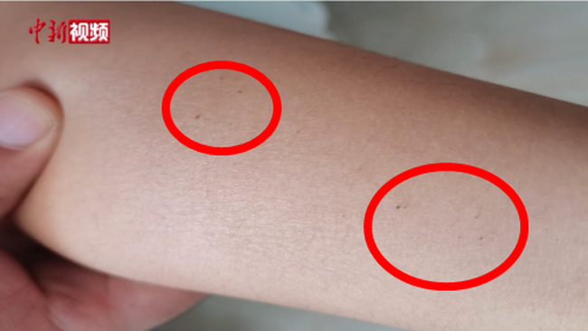 Hàng loạt học sinh mẫu giáo có vết kim đâm kỳ lạ trên cơ thể, lời kể của những đứa bé khiến ai cũng phải xót xa-1