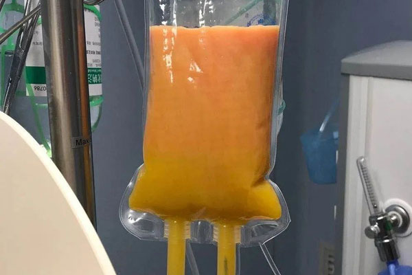 Ăn gà rán, 2 ngày sau sản phụ bị đau bụng, bác sĩ phải lọc huyết tương để cứu, các tạp chất lọc ra vàng như mỡ-1