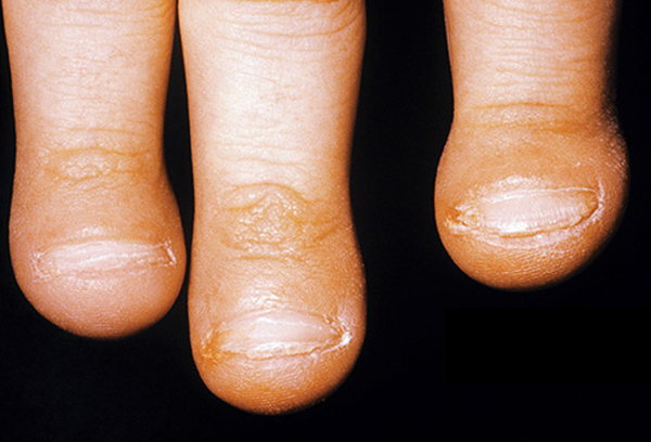 Các triệu chứng gây bất ngờ của ung thư phổi-1