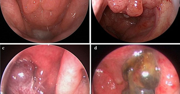 Ung thư vòm họng - căn bệnh nhạc sĩ Trần Tiến đang mắc nguy hiểm thế nào?-1