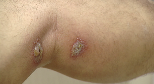 Gần 100 người nhập viện mỗi ngày vì tiếp xúc với kiến ba khoang-1