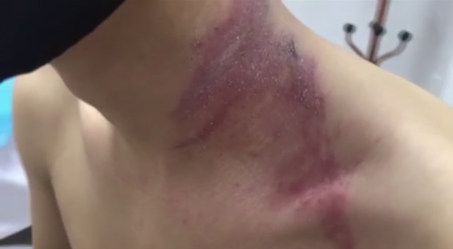 Gần 100 người nhập viện mỗi ngày vì tiếp xúc với kiến ba khoang-2