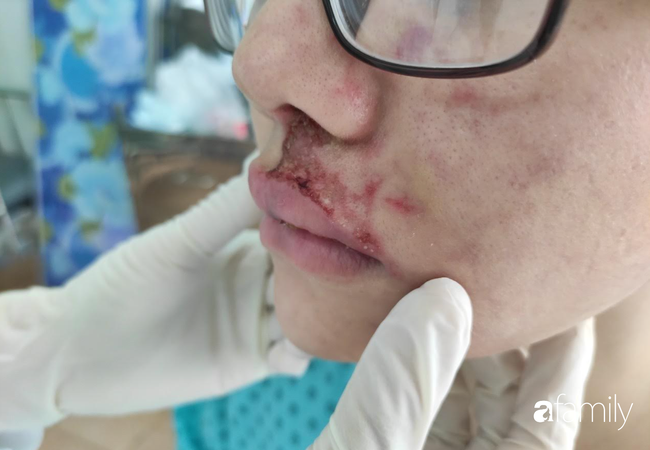TP.HCM: Tiêm filler vào vùng rãnh má với giá 3.5 triệu đồng để làm đẹp, mặt cô gái 26 tuổi sưng phù, mưng mủ nặng nề-2