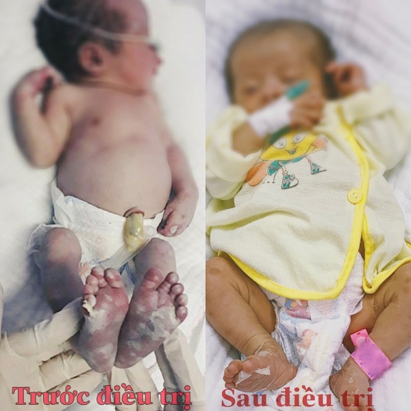 Bé sơ sinh vừa chào đời đã mắc giang mai, sau 20 ngày điều trị, bé đã ổn định-1