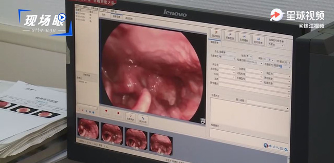 Chạy theo trào lưu ly trà sữa đầu tiên vào mùa thu, người phụ nữ ho ra máu, bác sĩ lắc đầu ngán ngẩm-2