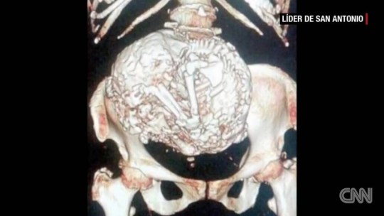 Kinh ngạc câu chuyện thai nhi nằm trong tử cung một người phụ nữ trong 60 năm-2