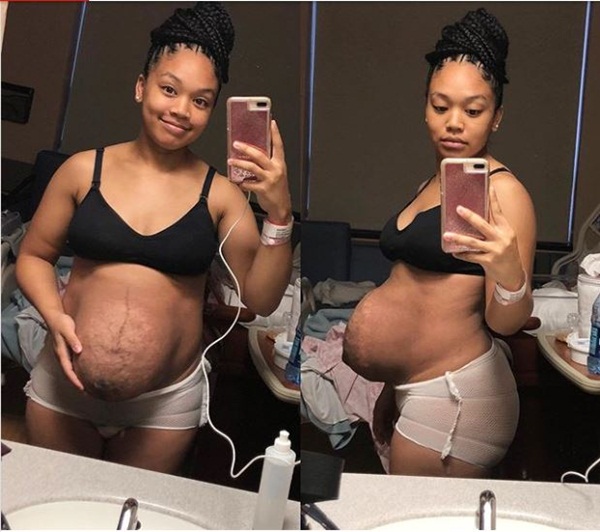 Bà mẹ dũng cảm phơi bày vòng 2 trần trụi sau khi sinh: Cứ như bầu đứa nữa, thâm rạn đến đáng sợ-1