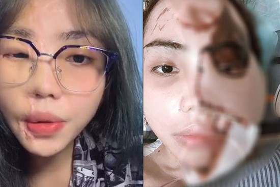 Cô gái bị chồng sắp cưới tạt axit lần đầu lộ diện cả khuôn mặt, tiết lộ 16 lần phẫu thuật đau đớn