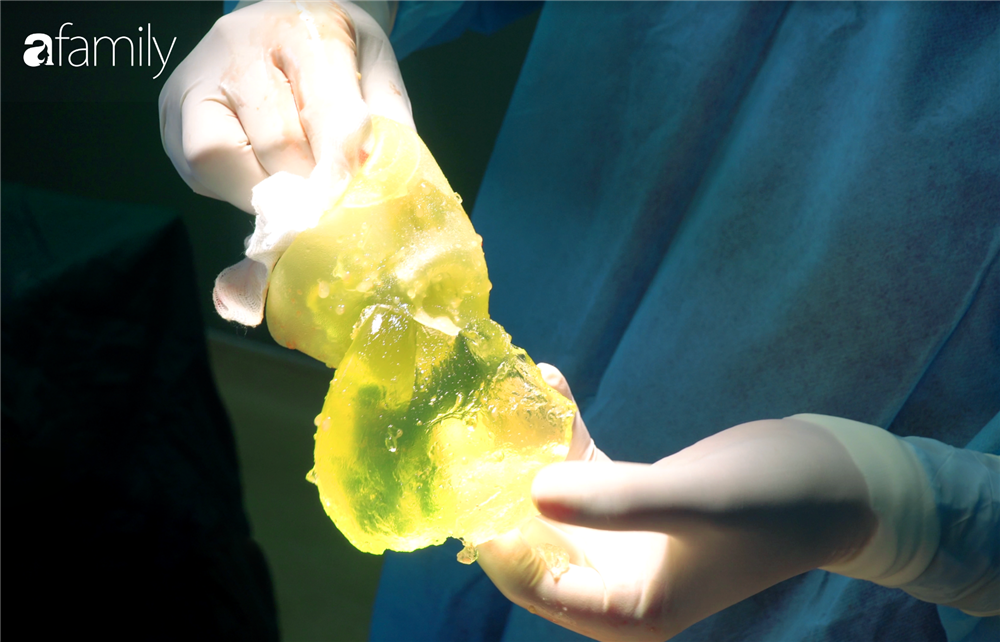 TP.HCM: Đi nâng ngực tại thẩm mỹ viện trôi nổi, người phụ nữ bị vỡ túi ngực nặng nề-2