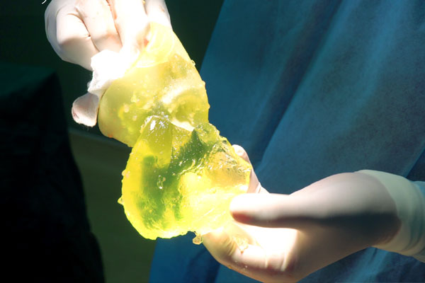 Tiêm mỡ tự thân làm đẹp, cô gái Hà Thành phải rạch mặt sưng nề để nặn ổ mủ-3