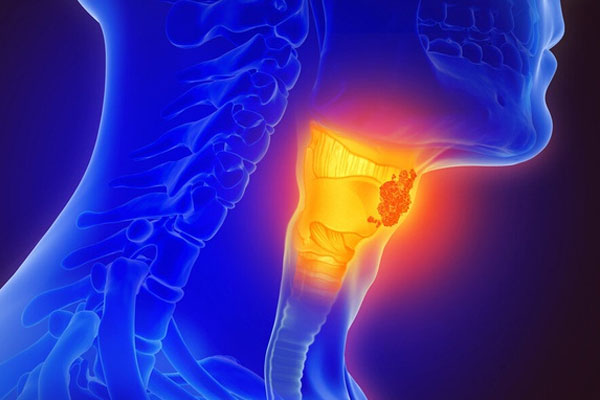 Australia tìm ra cách chẩn đoán ung thư bằng hơi thở-1