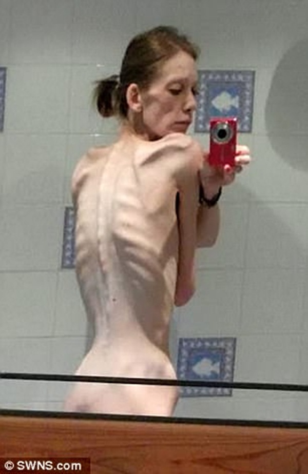 Cô gái bị ví như bộ xương di động, yếu đến mức bác sĩ khuyên gia đình chuẩn bị tâm lý vĩnh biệt, 18 tháng sau điều kỳ diệu đã xảy ra-2