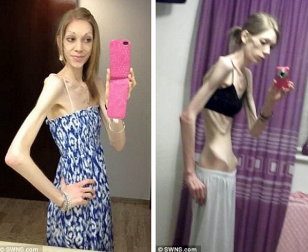 Cô gái bị ví như bộ xương di động, yếu đến mức bác sĩ khuyên gia đình chuẩn bị tâm lý vĩnh biệt, 18 tháng sau điều kỳ diệu đã xảy ra-3