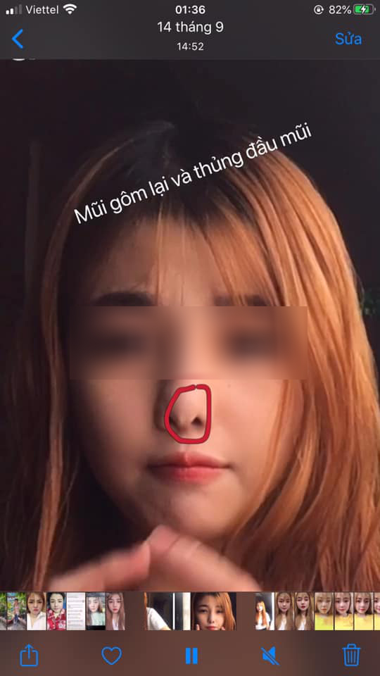 Từ câu chuyện lòi vách ngăn đầu mũi của cô gái trẻ, bác sĩ chỉ ra điều cần khắc cốt ghi tâm trong ăn uống khi nâng mũi làm đẹp-2