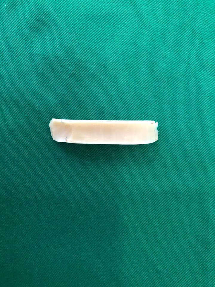 Từ câu chuyện lòi vách ngăn đầu mũi của cô gái trẻ, bác sĩ chỉ ra điều cần khắc cốt ghi tâm trong ăn uống khi nâng mũi làm đẹp-3