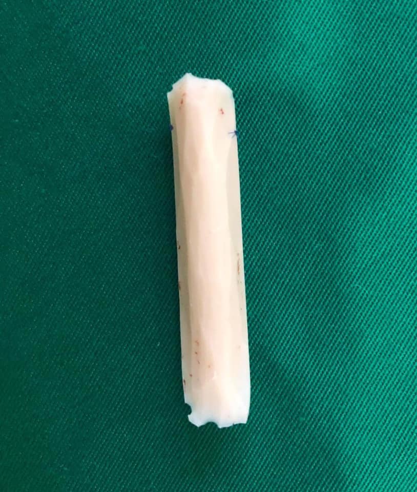 Từ câu chuyện lòi vách ngăn đầu mũi của cô gái trẻ, bác sĩ chỉ ra điều cần khắc cốt ghi tâm trong ăn uống khi nâng mũi làm đẹp-4